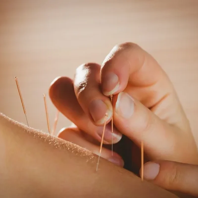 depositphotos_81821302-stock-photo-young-woman-getting-acupuncture-treatment